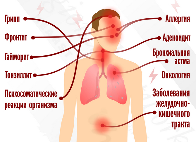 Кондиционеры и здоровье: кашель и другие заболевания при использовании кондиционеров
